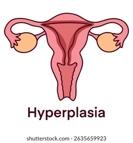 Ilustração médica do útero com hiperplasia, mostrando espessamento do revestimento endometrial. Visual educacional para ginecologia, patologia e saúde reprodutiva