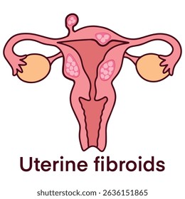 Medical illustration of uterus with multiple fibroid tumors. Educational vector used for gynecology, patient education, and diagnostic materials