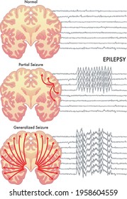 Medical Illustration Of The Various Symptoms Of Epilepsy.