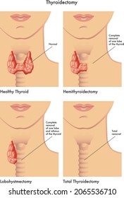 Medical Illustration Of The Various Types Of Thyroidectomy.