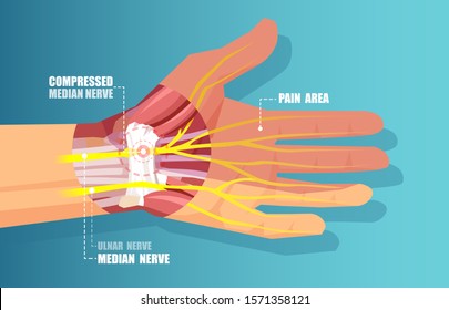 Medical illustration vector of a carpal tunnel syndrome with median nerve compression 
