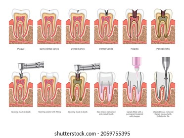 Medical illustrations of dental treatment. Stages of decay of a carious tooth.