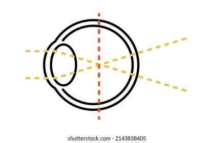 Medical Illustrations of Vision and Refractive Errors, by Myopia (focus in front of the retina)