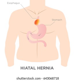 Medical image of Hiatus hernia