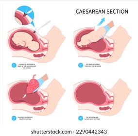 Medical Infant Childbirth Delivery Caesarean C section newborn Baby birth prolapse umbilical cord twins scar womb tummy women Fetal fetus mother belly Labour feet pain born