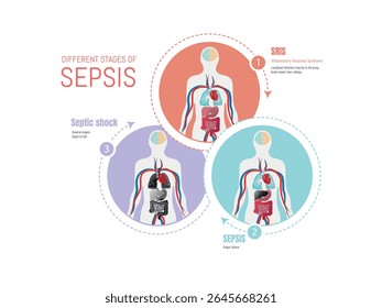 Medical infographic explaining the different stages of sepsis, from systemic inflammatory response syndrome - sirs - to sepsis and septic shock, showing human body anatomy with affected organs