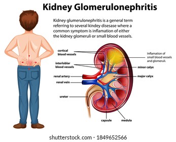 Medical infographic of kidney glomerulosclerosis illustration