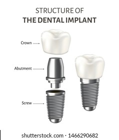 Medical infographic representing a structure of the dental implant. Vector illustration isolated on the white background. Educational poster showing components of implant: crown, abutment, screw.