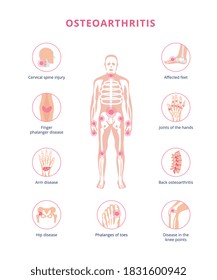 Medical infographic scheme of osteoarthritis joint damage in human body, flat vector illustration isolated on white background. Osteoarthritis and arthritis disease.