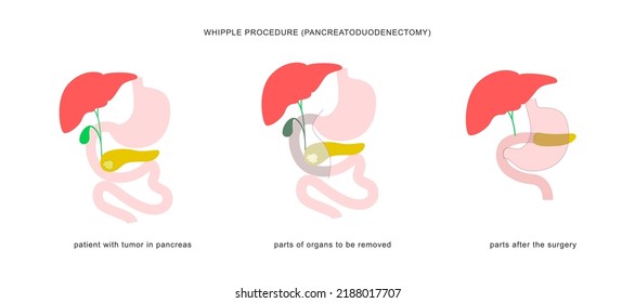 Medical Infographic Of Whipple Procedure Pancreaticoduodenectomy. Surgery Operation In Treatment Of Pancreatic Cancer.