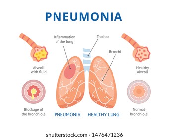 22,949 Lung infection Stock Vectors, Images & Vector Art | Shutterstock