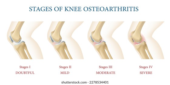 Medizinische Infografiken. Kniegelenk-Osteoarthritis Stadien, Vektorgrafik der Anatomie des menschlichen Körpers mit Knie-Knochen, gesunde und verdünnte Knorpel. Gelenkschmerzen, Entzündungssymptome der Osteoarthritis