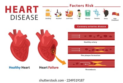 Infografía médica de ataques cardíacos y corazón humano con enfermedad arterial coronaria.