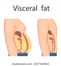 Medical poster about visceral fat. Abdominal fat surrounds the inner doors of the abdominal cavity. Overweight disease concept. Weight loss, liposuction, and diet.