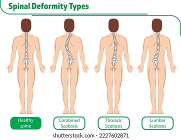 Medical poster demonstrating types of scoliosis on white background. Illustration of healthy and diseased spine