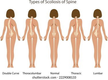 Medical poster demonstrating types of scoliosis on white background. Illustration of healthy and diseased spine