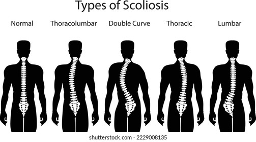 Medical poster demonstrating types of scoliosis on white background. Illustration of healthy and diseased spine, banner design