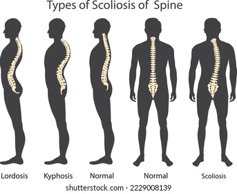 Medical poster demonstrating types of scoliosis on white background. Illustration of healthy and diseased spine