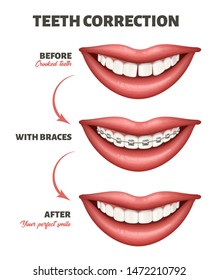 Medical poster showing all stages of teeth correction process: crooked teeth, with braces, perfect smile. Vector illustration of human smile, teeth and dental braces isolated on the white background.