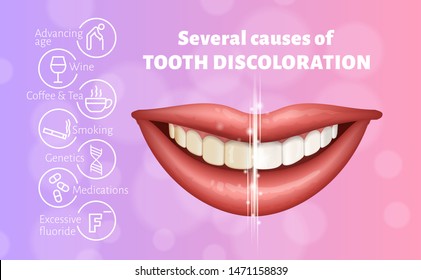 Medical poster showing causes of tooth discoloration. Educational infographic concept. Realistic vector illustration with informational icons. Image depicting human smile, teeth before and after.