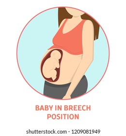 Medical Reasons For Cesarean Delivery Or C-section. Baby Fetus In Breech Position. Emergency Case. Isolated Vector Flat Illustration