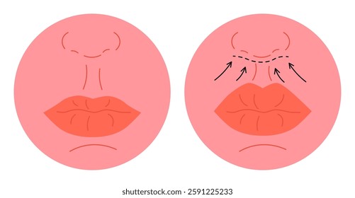 Medical scene of cosmetic lip lift surgery. Before and after comparison. Incision, lifting process and transformation of upper lip. Aesthetic enhancement, facial rejuvenation. Flat vector illustration