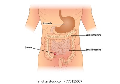 medical stoma vector