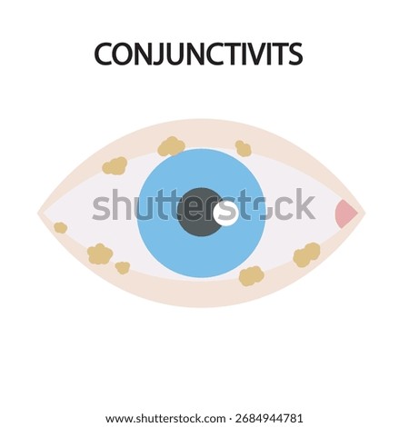 Medical vector of conjunctivitis showing red, itchy, watery eyes with swelling. Highlights symptoms and distinguishes from allergies, dry eye, and blepharitis.