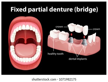 Medical Vector of Fixed Partial Denture illustration