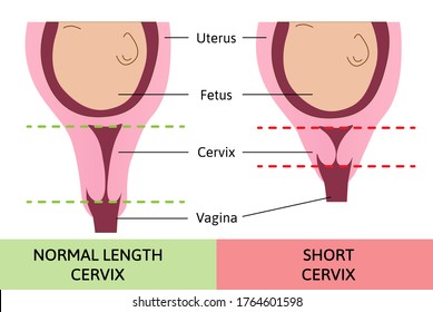 Medical Vector Illustration About Normal And Short Cervix. Pregnancy Problem. Child In Womb Or Uterus. Image Is Marked With Lines.