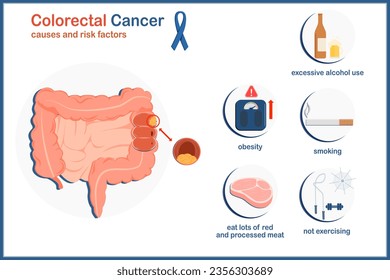 medical vector illustration Causes and risk factors that cause colon cancer.Obesity,drinking alcohol,not exercising,eating red and processed meat and smoking.flat style isolated on white background.