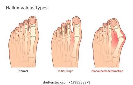 Medical vector illustration of Hallux valgus types. Healthy foot, initial stage and pronounced deformation. 