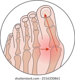 Medical vector illustration of Hallux valgus. Circled footnote