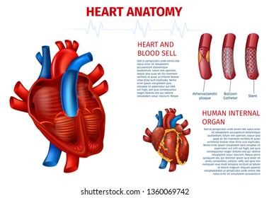 Medical Vector Illustration Of Realistic Human Heart Outside And Cutaway Anatomy, Blood Vessels And Cell. Modern Method Of Cardiovascular Problem Elimination With Balloon Catheter, Stent Treatment.