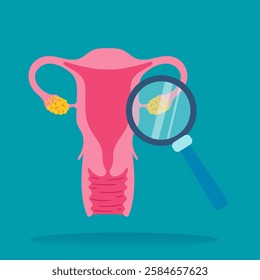 Medical vector illustration representing polycystic ovary syndrome diagnosis, showing uterus and ovaries examined with magnifying glass