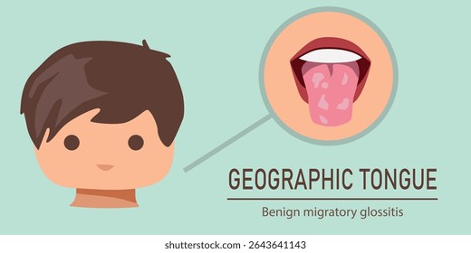 Medical vector infographic of geographic tongue in a child, showing pink tongue with smooth patches and glossitis symptoms