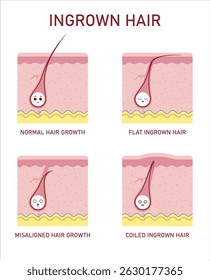 Medical vector poster in English showing four types of hair growth: normal, flat ingrown, deviated, and spiral. Educational chart for dermatology and esthetician training.