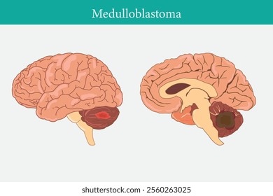 medulloblastoma, human brain cross section side view. eps 10