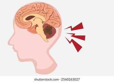 medulloblastoma, human brain cross section side view. eps 10