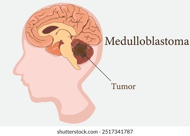 medulloblastoma, human head and brain cross section side view. eps 10