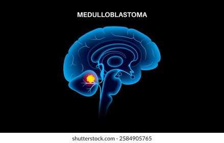 Medulloblastoma medical poster. Cancerous brain tumor in children. Cerebellum disease concept. Neoplasm in the child silhouette. Problem with balance, coordination, and optic nerve vector illustration