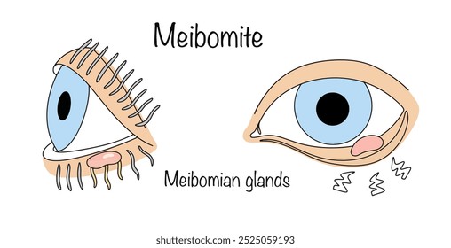 Meibomite. An ophthalmological disease in which inflammation of the inner surface of the eyelid occurs. Hand-drawn inflammation and suppuration of the meibomian glands. Vector illustration.