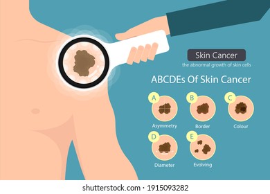 Melanocytes stages exam skin cancer cell screening diagnosis dermis dermoscopic basal surface mole keratosis test Mohs keratoses solar sun UV expose detect treat sunburn