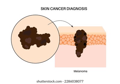 Melanoma anatomical poster, skin cancer development. Malignant tumor growth into the skin layers from epidermis to other internal organs. Diagnostic and treatment in dermatology clinic flat vector