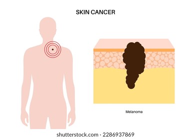 Melanoma anatomical poster, skin cancer development. Malignant tumor growth into the skin layers from epidermis to other internal organs. Diagnostic and treatment in dermatology clinic flat vector