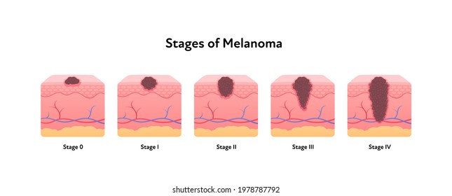 Melanoma cancer anatomical infographic poster. Vector flat medical illustration. Stages of tumor disease. Design for healthcare, oncology, dermatology.