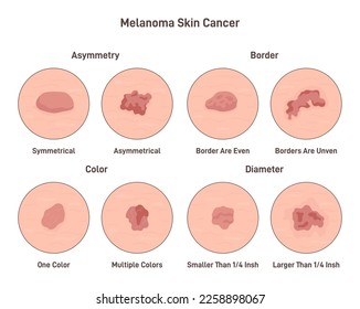 Melanoma cancer. Anatomical infographic poster. Dermatology and oncology disease. Asymmetry, border, color and diameter differences. Flat vector illustration