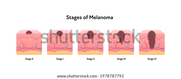 Melanoma Cancer Anatomical Infographic Poster Vector Stock Vector ...