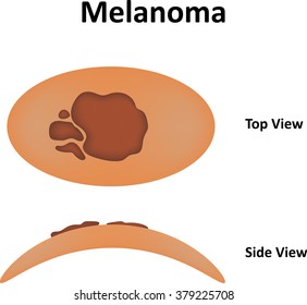 Melanoma Diagram
