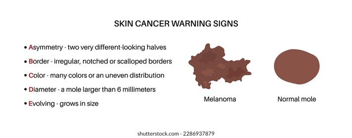 Melanoma and normal mole comparison, skin cancer warning signs, ABCDE rules poster. Malignant tumor melanocyte cells growing into skin layers. Oncology prevention medical flat vector illustration